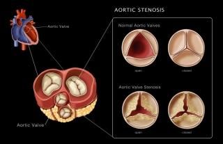 Posterazzi ݥץȥ쥯 Aortic Valves Normal and Stenosis Illustration Monica 
