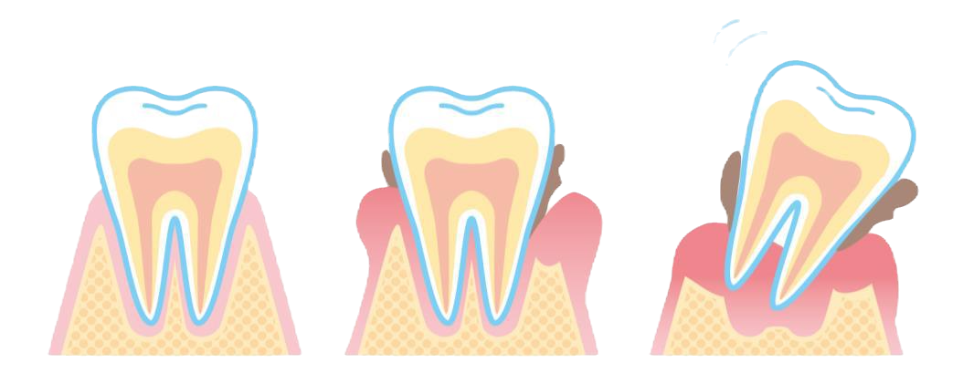 歯周病の抑制