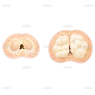 前立腺肥大 Sサイズ Laiman Stockweb メディカルイラスト素材のダウンロード販売