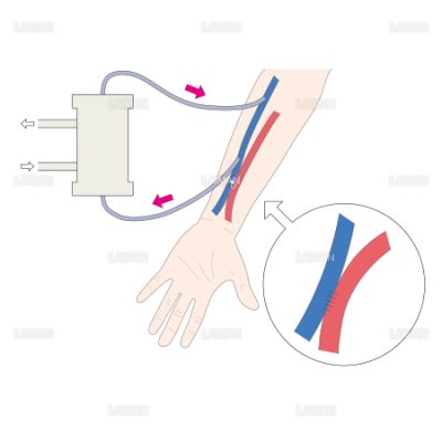 血液透析のしくみ Sサイズ Laiman Stockweb メディカルイラスト素材のダウンロード販売