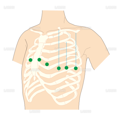 標準12誘導法 単極胸部誘導 Sサイズ Laiman Stockweb メディカルイラスト素材のダウンロード販売