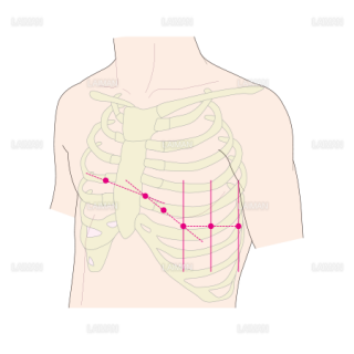 胸部誘導の吸盤の位置 （Sサイズ）
