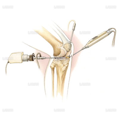 関節鏡下手術 ｍサイズ Laiman Stockweb メディカルイラスト素材のダウンロード販売