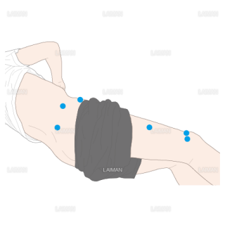 腸脛骨靱帯炎に関連する筋への低周波鍼通電の刺鍼点（Sサイズ）