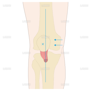 膝の診察　膝蓋骨を外方へ圧迫　�度（Sサイズ）