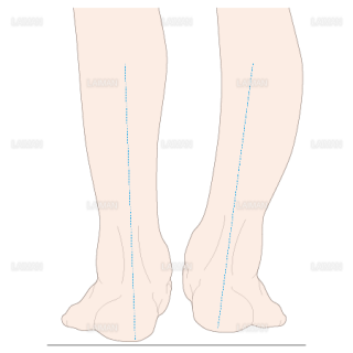下腿のアライメント　踵部内反（Sサイズ）