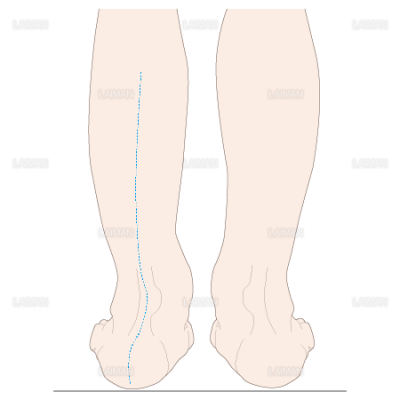 下腿のアライメント 踵部外反 Sサイズ Laiman Stockweb メディカルイラスト素材のダウンロード販売
