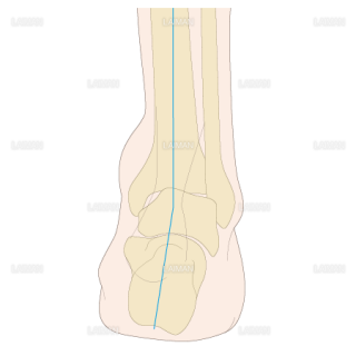 足部のアライメント　内反足（Sサイズ）