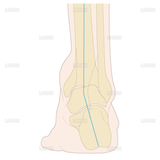 足部のアライメント　外反足（Sサイズ）