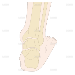 足部のアライメント　外反扁平足（Sサイズ）