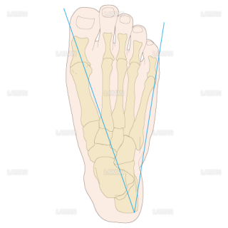 足部のアライメント　開帳足（Sサイズ）