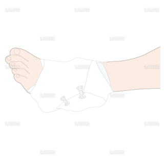 足関節内反捻挫の際のRICE処置　圧迫を加えながらバンテージを固定（Sサイズ）