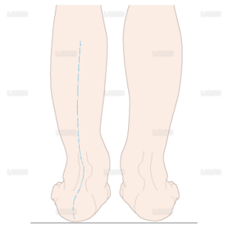下腿のアライメント　踵部外反（Ｍサイズ）