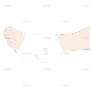 足関節内反捻挫の際のRICE処置　圧迫を加えながらバンテージを固定（Ｍサイズ）