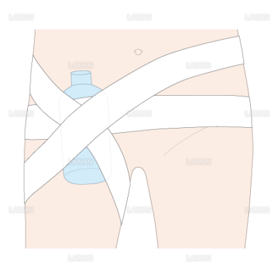 心臓カテーテル検査 刺入部 鼡径部 の止血方法 ｍサイズ Laiman Stockweb メディカルイラスト素材のダウンロード販売
