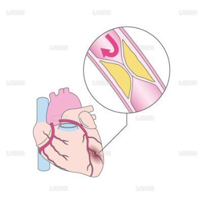 心筋梗塞 ｍサイズ Laiman Stockweb メディカルイラスト素材のダウンロード販売