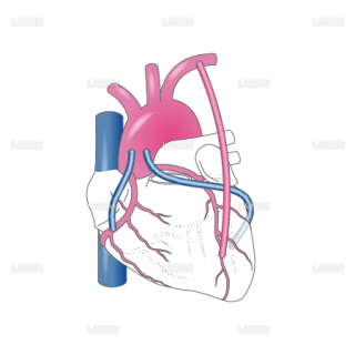 冠動脈バイパス術_心臓の図（Ｍサイズ）