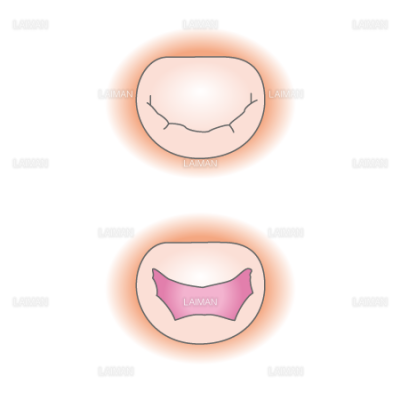 僧帽弁 上から見たところ Sサイズ Laiman Stockweb メディカルイラスト素材のダウンロード販売