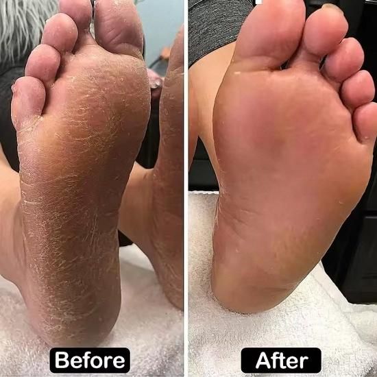 ラローナ フットケアマシン | 角質除去 - LALONA