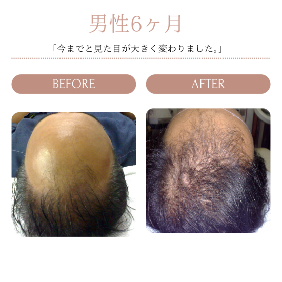 薬用HGドクターズヘアケアシリーズ｜HG MD®ローション