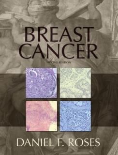 šBreast Cancer